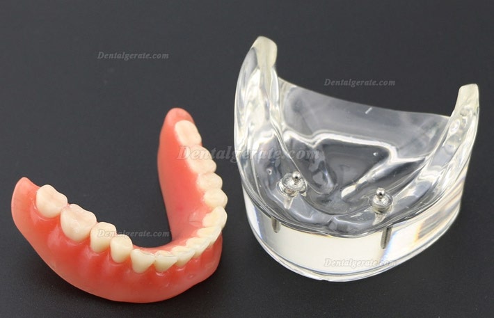 Modell f&uuml;r zahn&auml;rztliche Oberz&auml;hne Overdenture Superior 4 Implantate Demo Modell 6001 02
